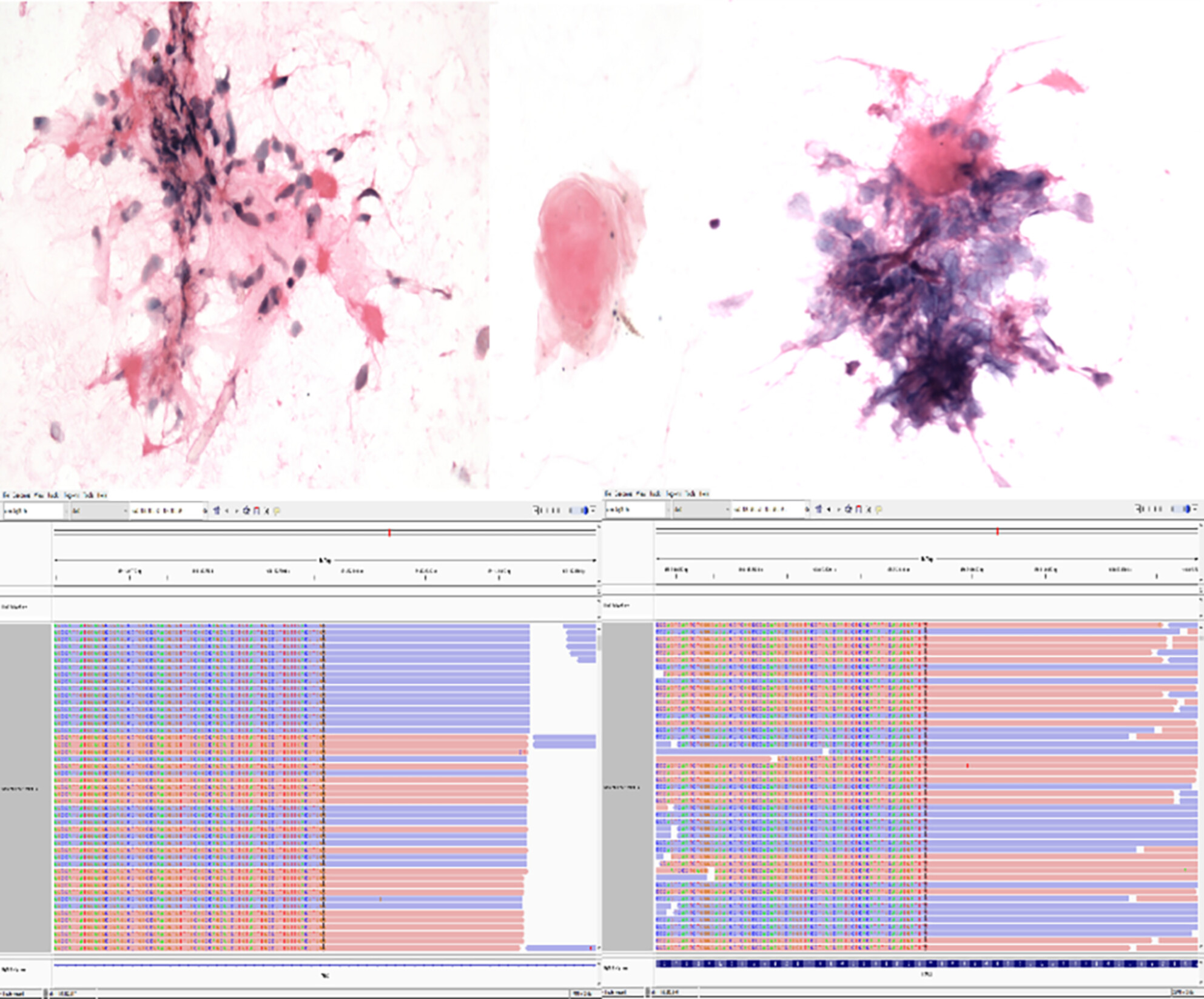Unveiling Diagnostic Clues of NTRK-Rearranged Spindle Cell Neoplasms in Fine-Needle Aspiration Specimens