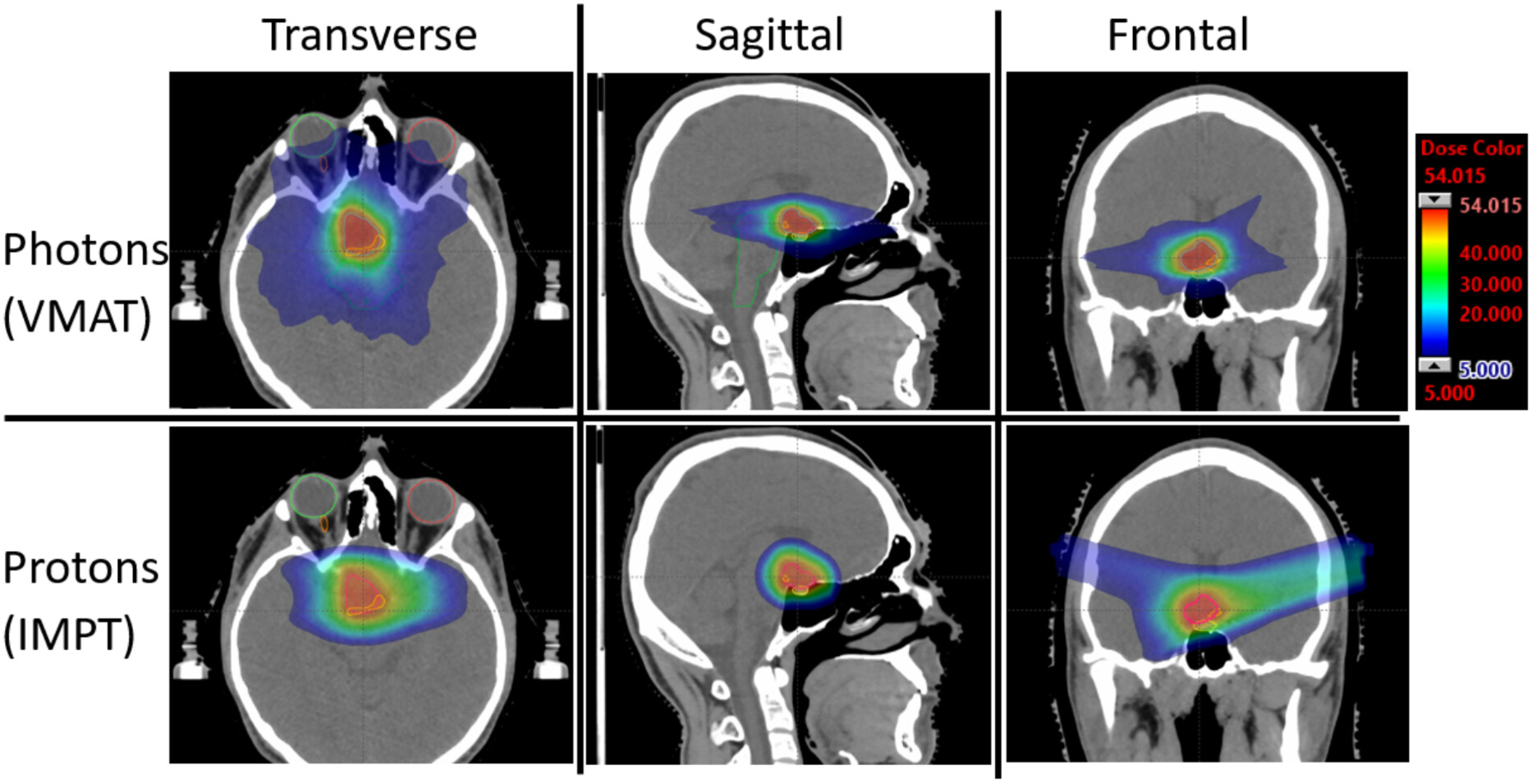 Is proton beam therapy always better than photon irradiation? Lessons from two cases