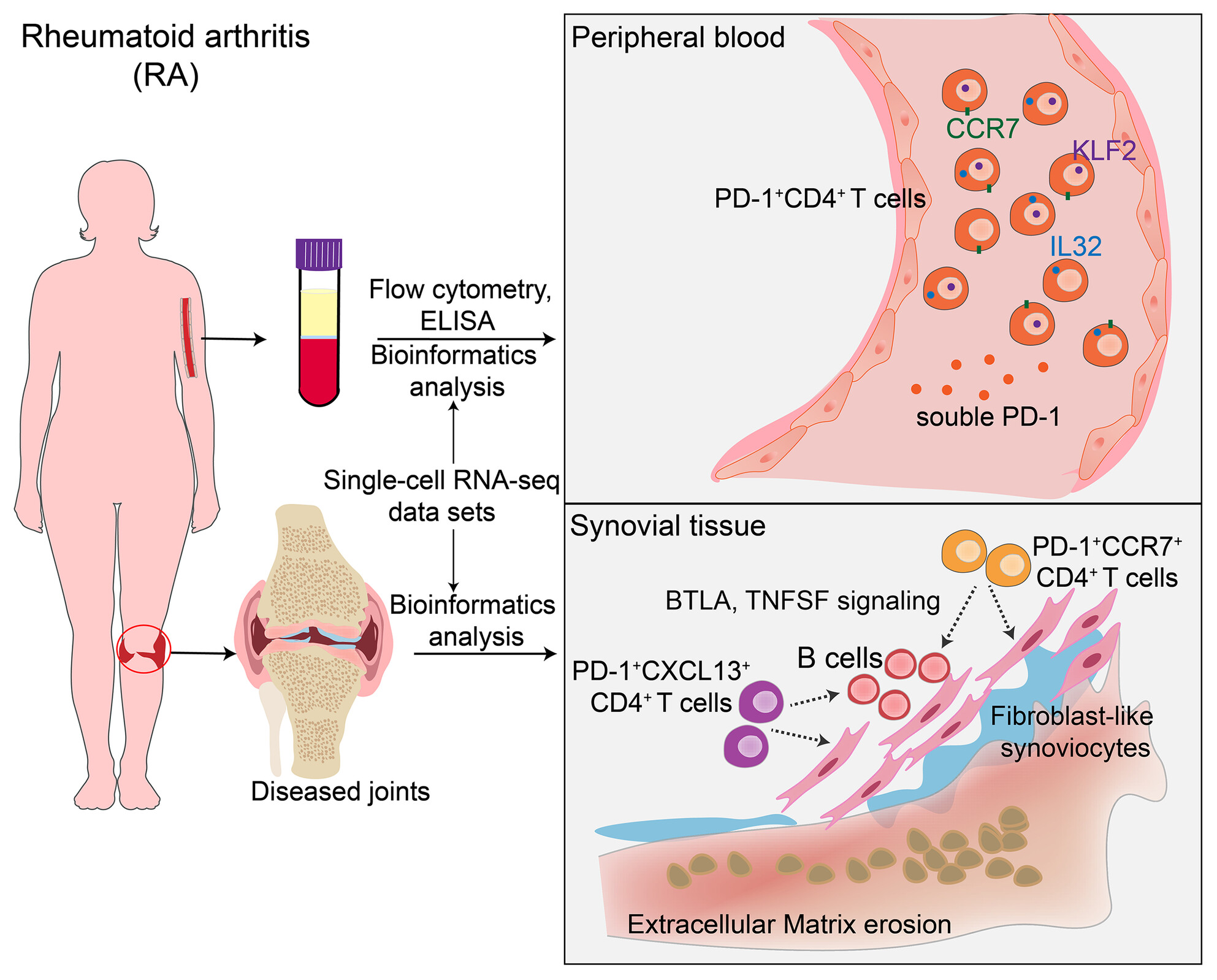 Characteristics of PD-1+CD4+ T cells in peripheral blood and synovium of rheumatoid arthritis patients