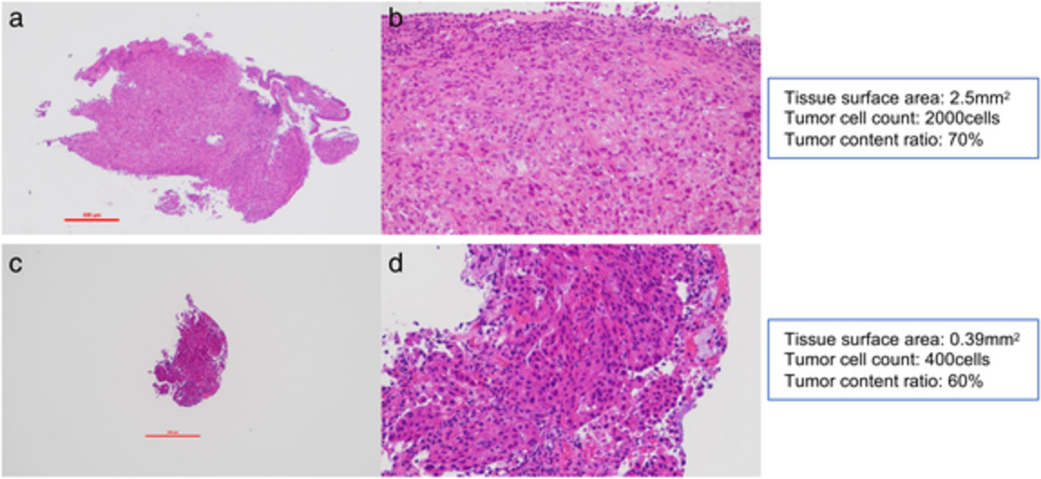 Tissue surface area and tumor cell count affect the success rate of the Oncomine Dx Target Test in the analysis of biopsy tissue samples