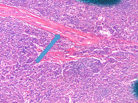 Multicentric Castleman disease with TAFRO syndrome and Sjögren's