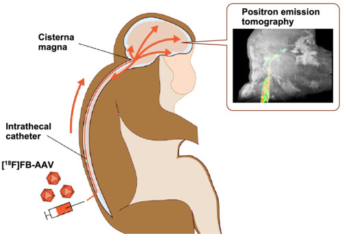 Early distribution of18 F-labeled AAV9 vectors in the cerebrospinal fluid after intracerebroventricular or intracisternal magna infusion in non-human primates