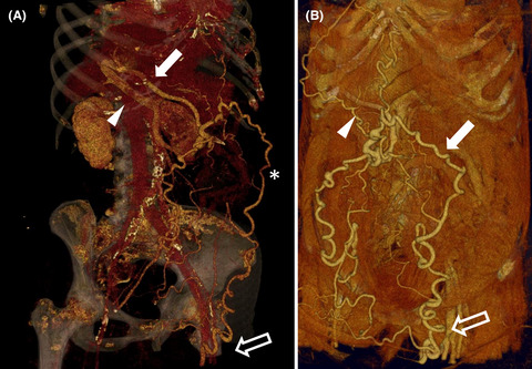 Spontaneous porto-femoral shunting in long-standing portal hypertension