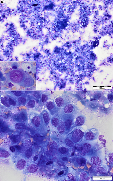 Mandibular metastasis of a prostatic carcinoma in a dog