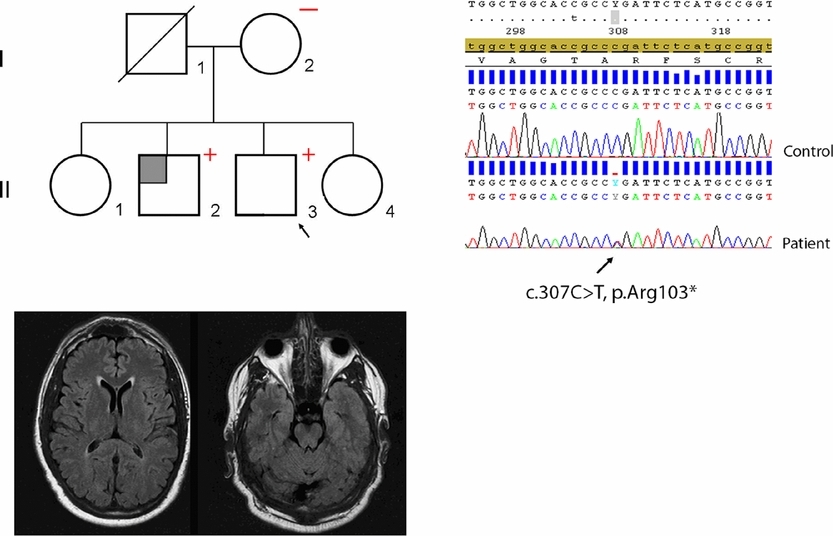 Hypomorphic NOTCH3 Alleles Do Not Cause CADASIL in Humans
