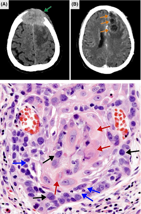 Craniocerebral metastases from a supraglottic squamous cell carcinoma: A case report and literature review