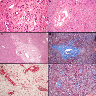 Obliterative portal venopathy: A neglected and probably misdiagnosed disease with peculiar etiology in South America