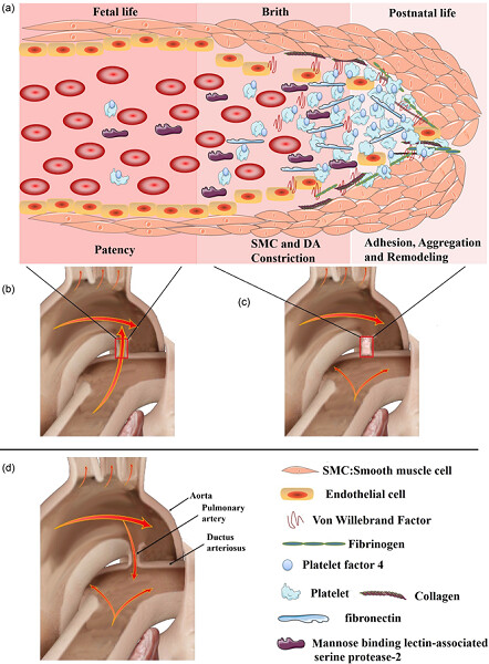 Altered plasma proteins released from platelets and endothelial cells are associated with human patent ductus arteriosus
