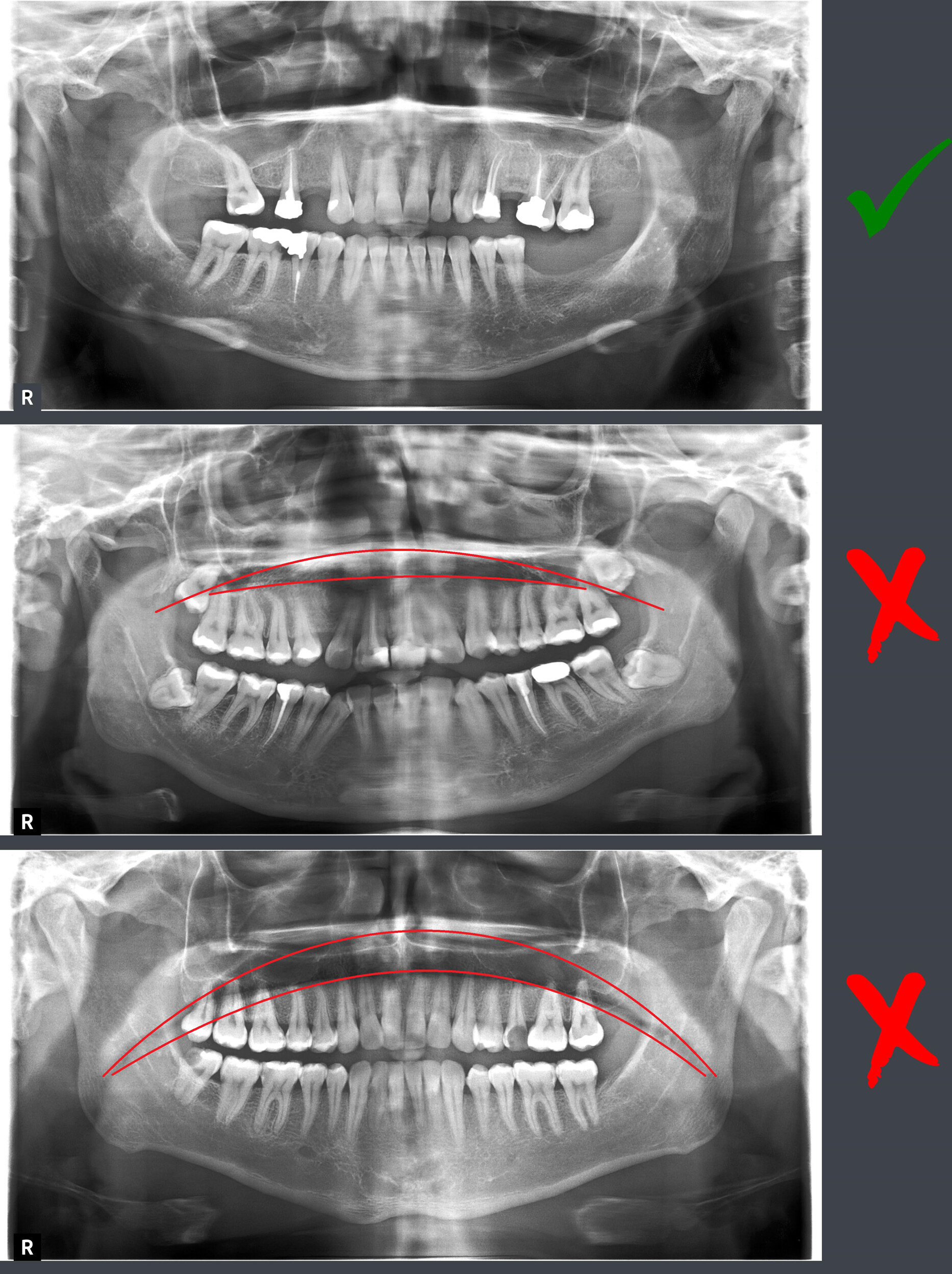Effect of using different strips on reducing the most common error in panoramic imaging: A randomised controlled trial on palatoglossal air space shadow