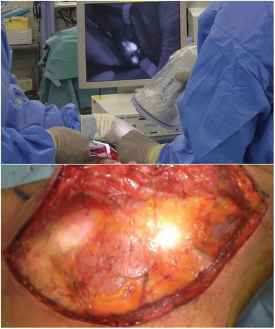 Novel color fluorescence imaging for sentinel lymph node detection in oral and oropharyngeal cancer
