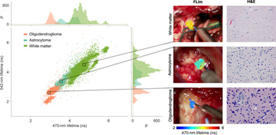 Intraoperative detection of IDH-mutant glioma using fluorescence lifetime imaging