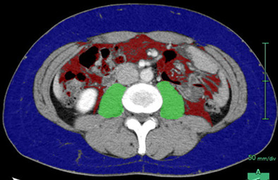 Impact of sarcopenia on chemotherapy-triggered exacerbation of interstitial lung disease in patients with non-small cell lung cancer