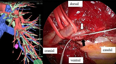 Metastatic pulmonary nodule after a seventeen-year disease-free interval resected through thoracoscopic subsegmentectomy: A case report