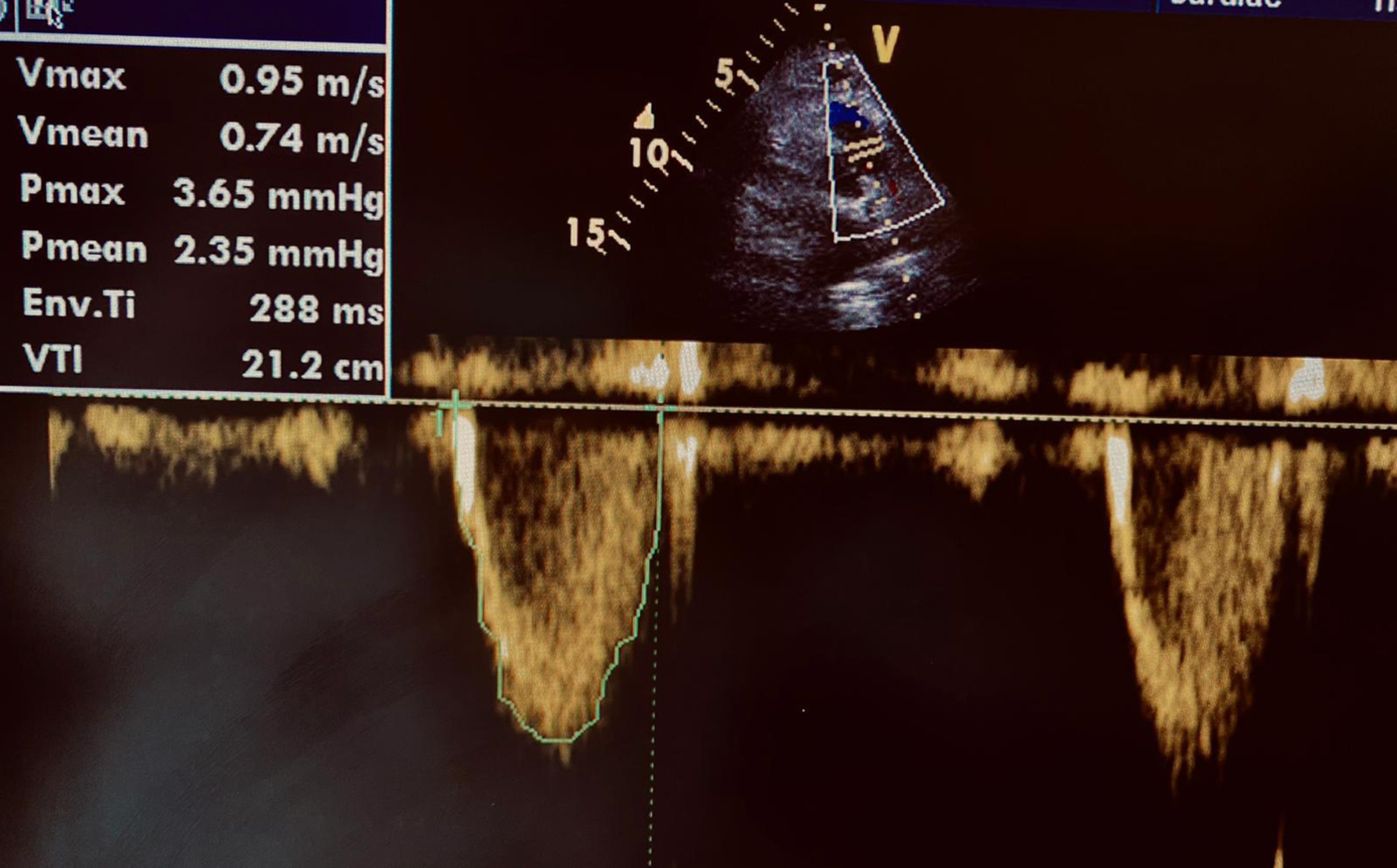 Cardiorenal syndrome type I recovery following heart rate correction: Cardiac output is not only stroke volume