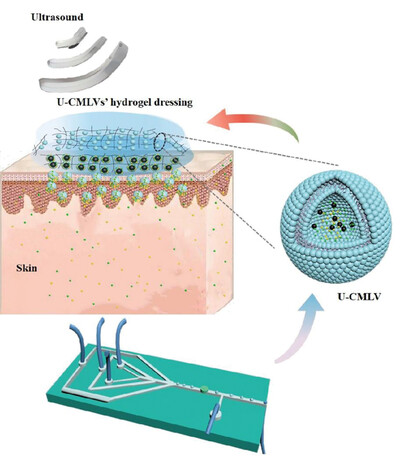 Development of a Microfluidic Formatted Ultrasound-Controlled Monodisperse Lipid Vesicles' Hydrogel Dressing Combined with Ultrasound for Transdermal Drug Delivery System