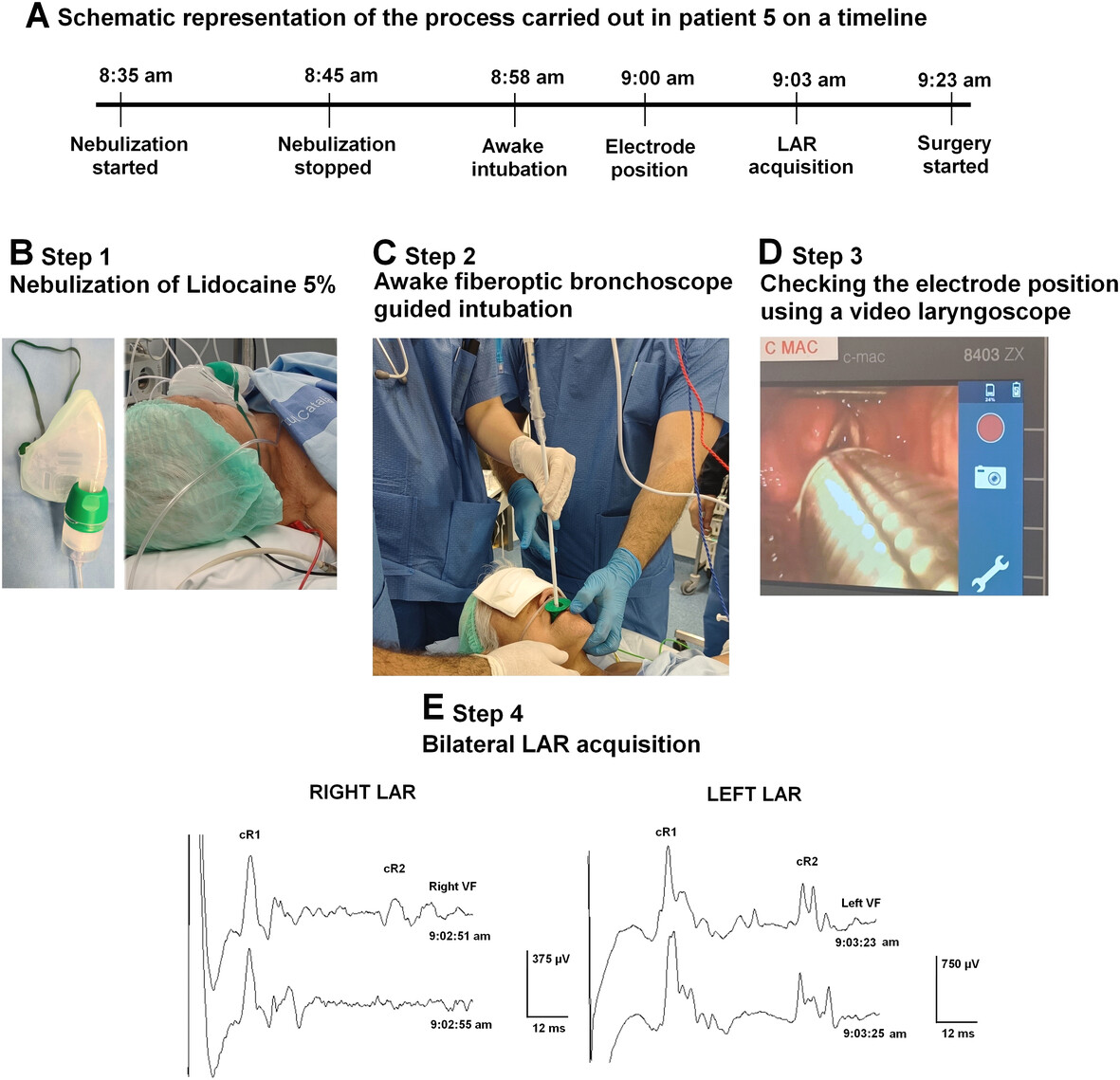 The Effects of Nebulized Lidocaine on the Laryngeal Adductor Reflex