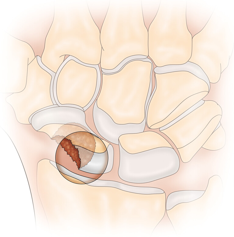 Locally Invasive Pigmented Villonodular Synovitis of the Wrist Treated by Arthroscopic Resection and Bone Grafting