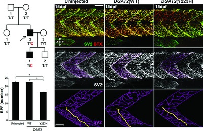 DGAT2 Mutation in a Family with Autosomal-Dominant Early-Onset Axonal Charcot-Marie-Tooth Disease