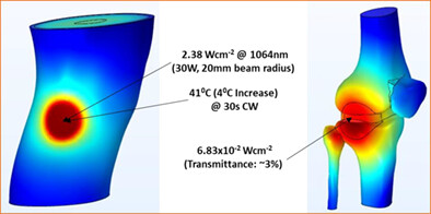 Three-dimensional irradiance and temperature distributions resulting from transdermal application of laser light to human knee—A numerical approach