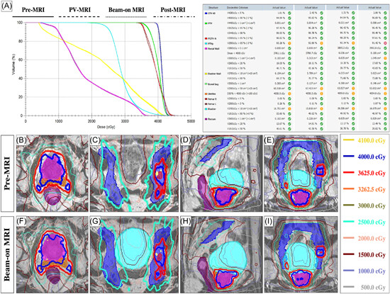 Adaptive ultra-hypofractionated whole-pelvic radiotherapy in high-risk and very high-risk prostate cancer on 1.5-Tesla MR-Linac: Estimated delivered dose and early toxicity results