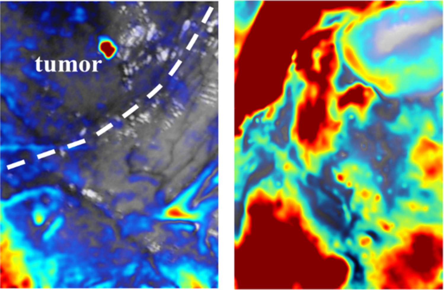 Neurosurgical brain tumor detection based on intraoperative optical intrinsic signal imaging technique: A case report of glioblastoma