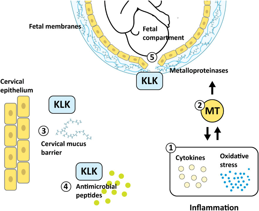 Microbial and human transcriptome in vaginal fluid at midgestation: Association with spontaneous preterm delivery