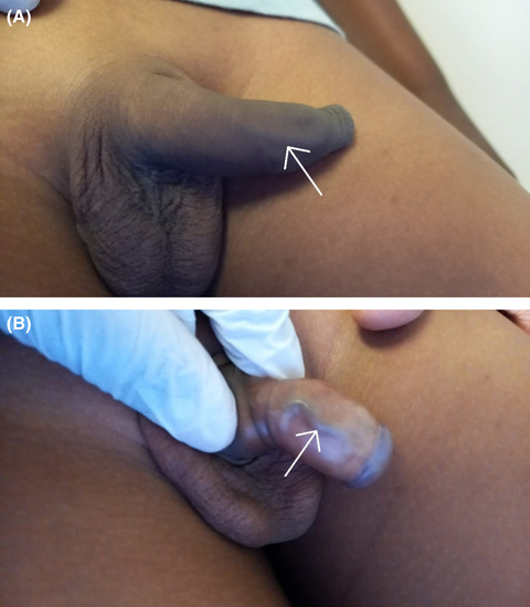 Dilated superficial penile dorsal vein in a child: Clinical images