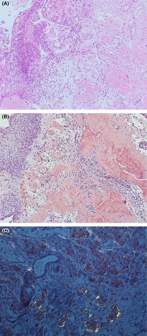 Primary bladder amyloidosis mimicking bladder cancer complicated by bladder rupture: A case report