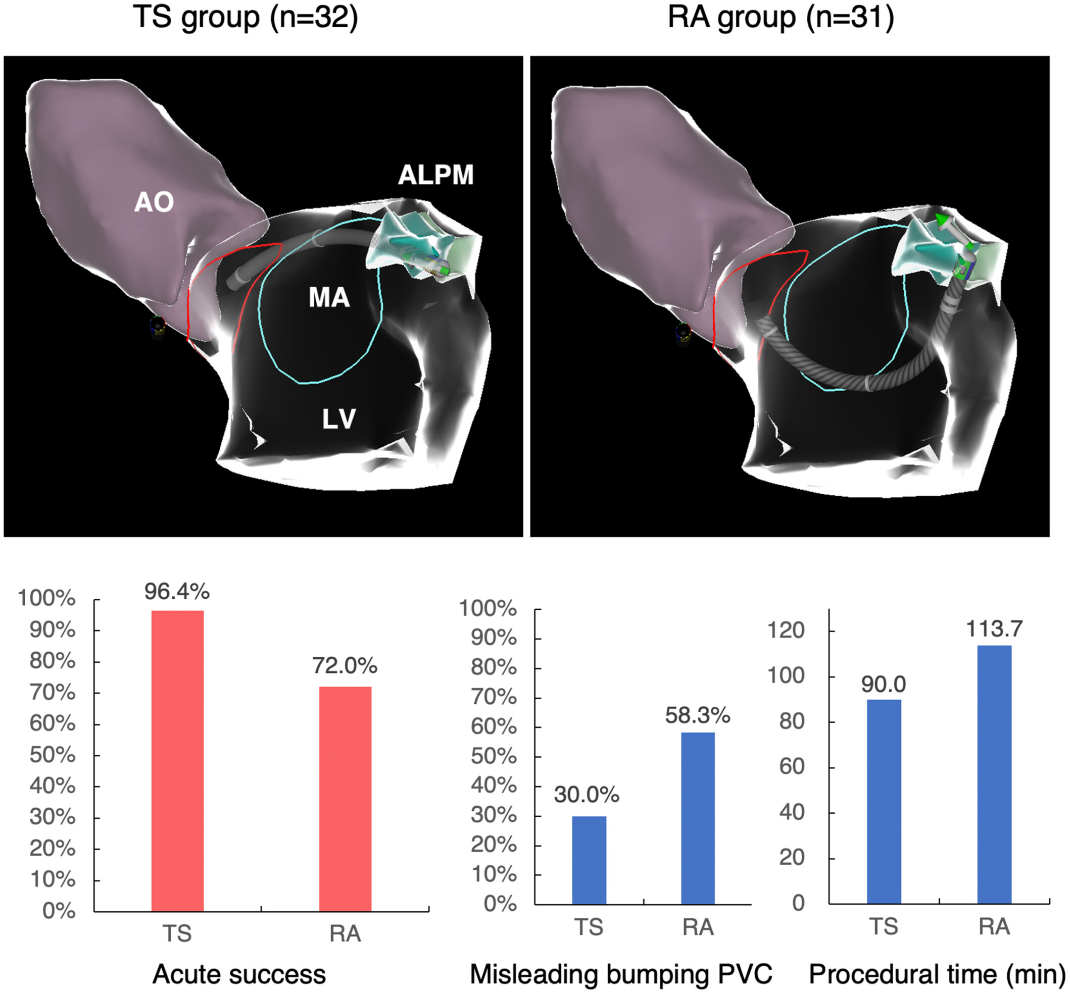 Transseptal approach versus retrograde aortic approach in mapping and ablation of ventricular arrhythmias from anterolateral papillary muscles