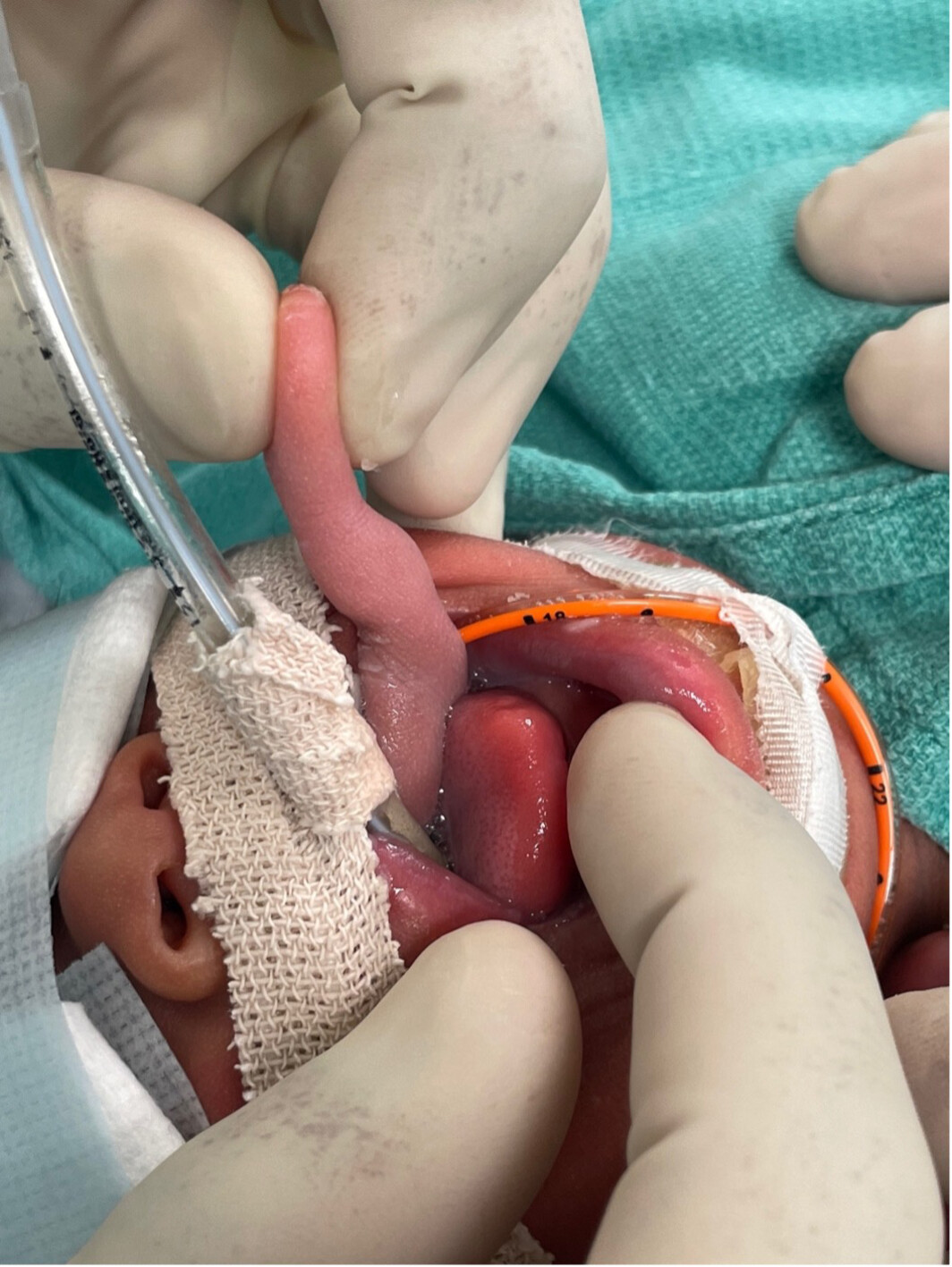 Large Nasopharyngeal Hairy Polyp Causing Immediate Respiratory Distress at Birth