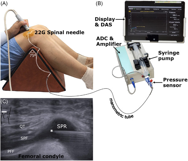 Intra-articular pressure characteristics of the knee joint: An exploratory study
