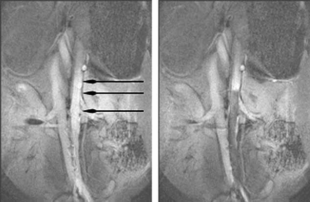 A new type of susceptibility-artefact-based magnetic resonance angiography: intra-arterial injection of superparamagnetic iron oxide particles (SPIO) A Resovist® in combination with TrueFisp imaging: a feasibility study