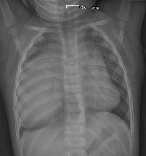 Massive thymic hyperplasia in a 15-month-old boy: Case report and literature review