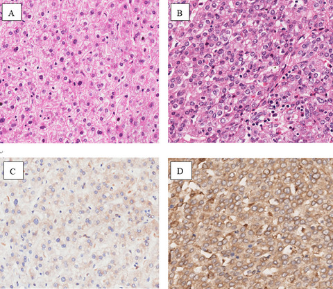 High expression of FAM13A was associated with increasing the liver cirrhosis risk
