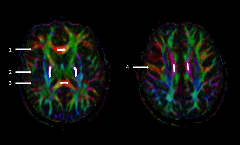 Diffusion tensor imaging and disability progression in multiple sclerosis: A 4-year follow-up study