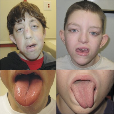 GeneMatcher Aids in the Identification of a New Malformation Syndrome with Intellectual Disability, Unique Facial Dysmorphisms, and Skeletal and Connective Tissue Abnormalities Caused by De Novo Variants in HNRNPK
