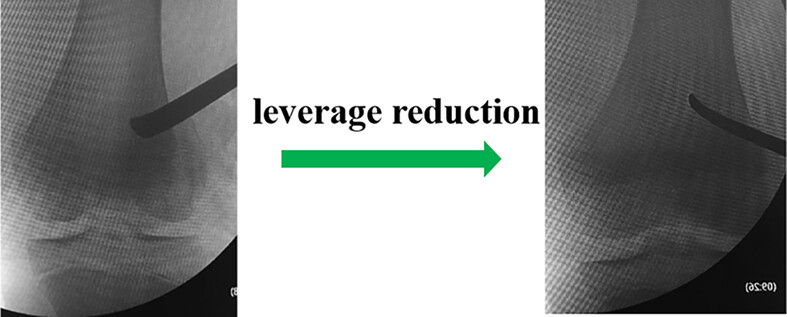 Minimally Invasive Percutaneous Leverage Reduction in the Treatment of Pediatric Salter–Harris IV and V Distal Femoral Physeal Fractures