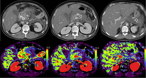 Prediction of the progression of walled-off necrosis in patients with acute pancreatitis on whole pancreatic perfusion CT