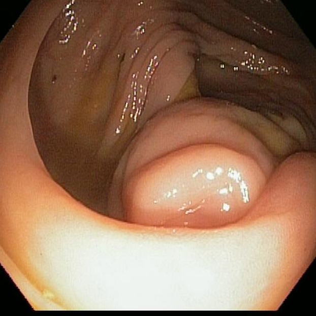 An unusual case of solid appendicular mass in a young female