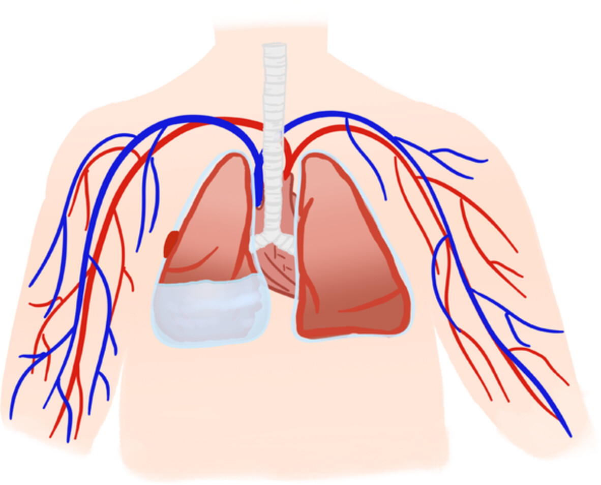 Diagnostic value of microRNAs for malignant pleural mesothelioma: A mini-review