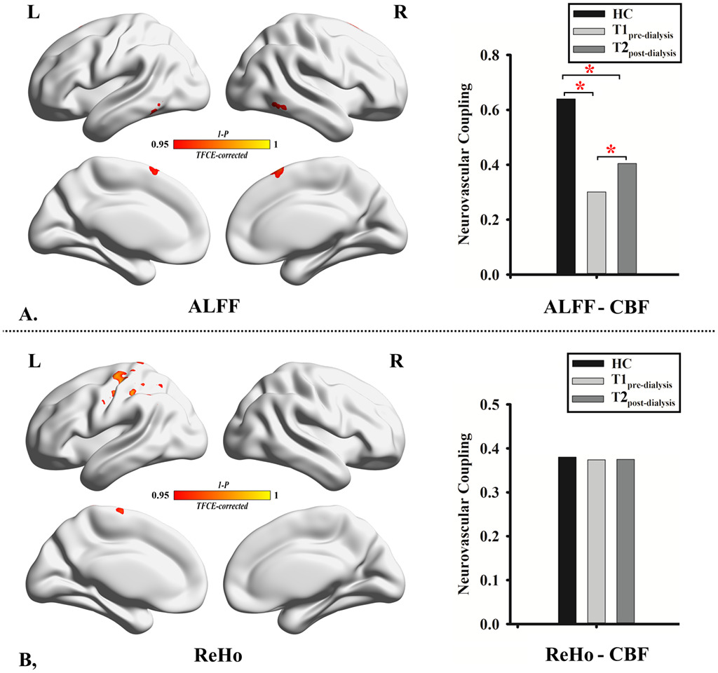 Reversal of neurovascular decoupling and cognitive impairment in patients with end-stage renal disease during a hemodialysis session: Evidence from a comprehensive fMRI analysis