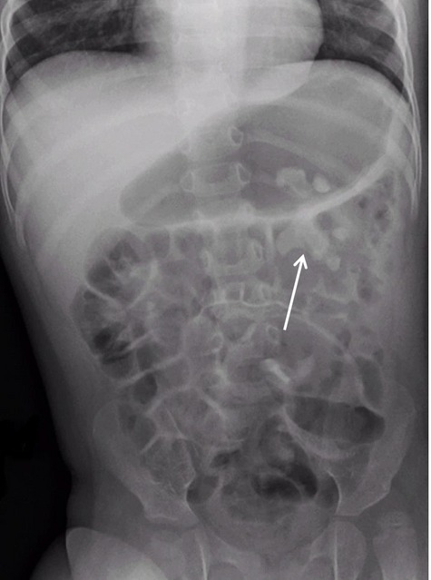 Topiramate-induced nephrolithiasis