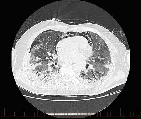 Imatinib for bleomycin induced pulmonary toxicity: a case report and evidence-base review