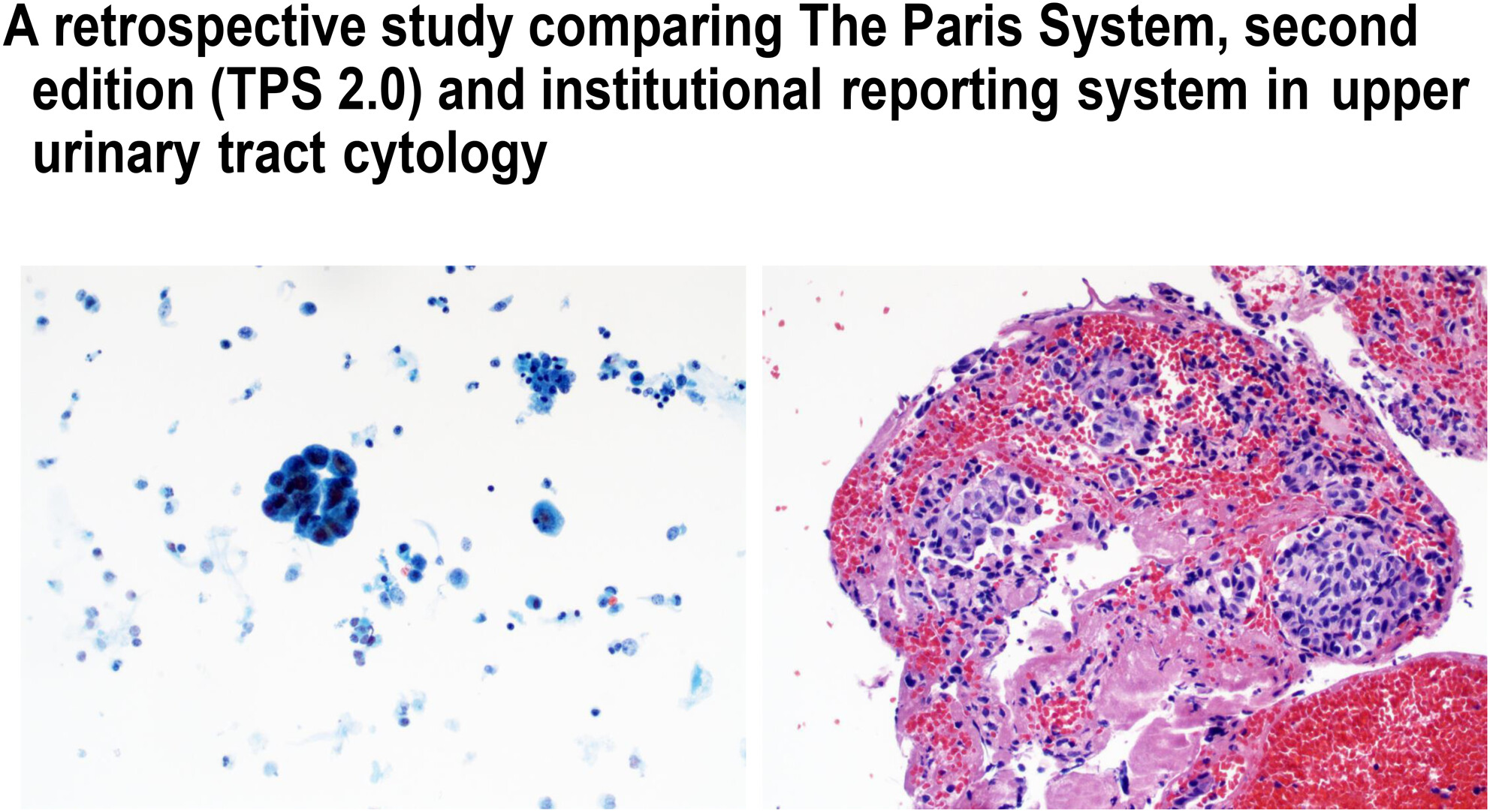 Cytologic evaluation of upper urinary tract specimens: An institutional retrospective study using The Paris System for Reporting Urine Cytology second edition with histopathologic follow-up