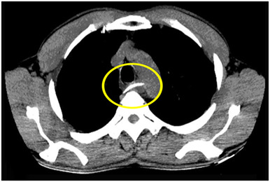 Safe endoscopic removal of ingested fish bone with esophageal perforation and impingement on the aortic wall