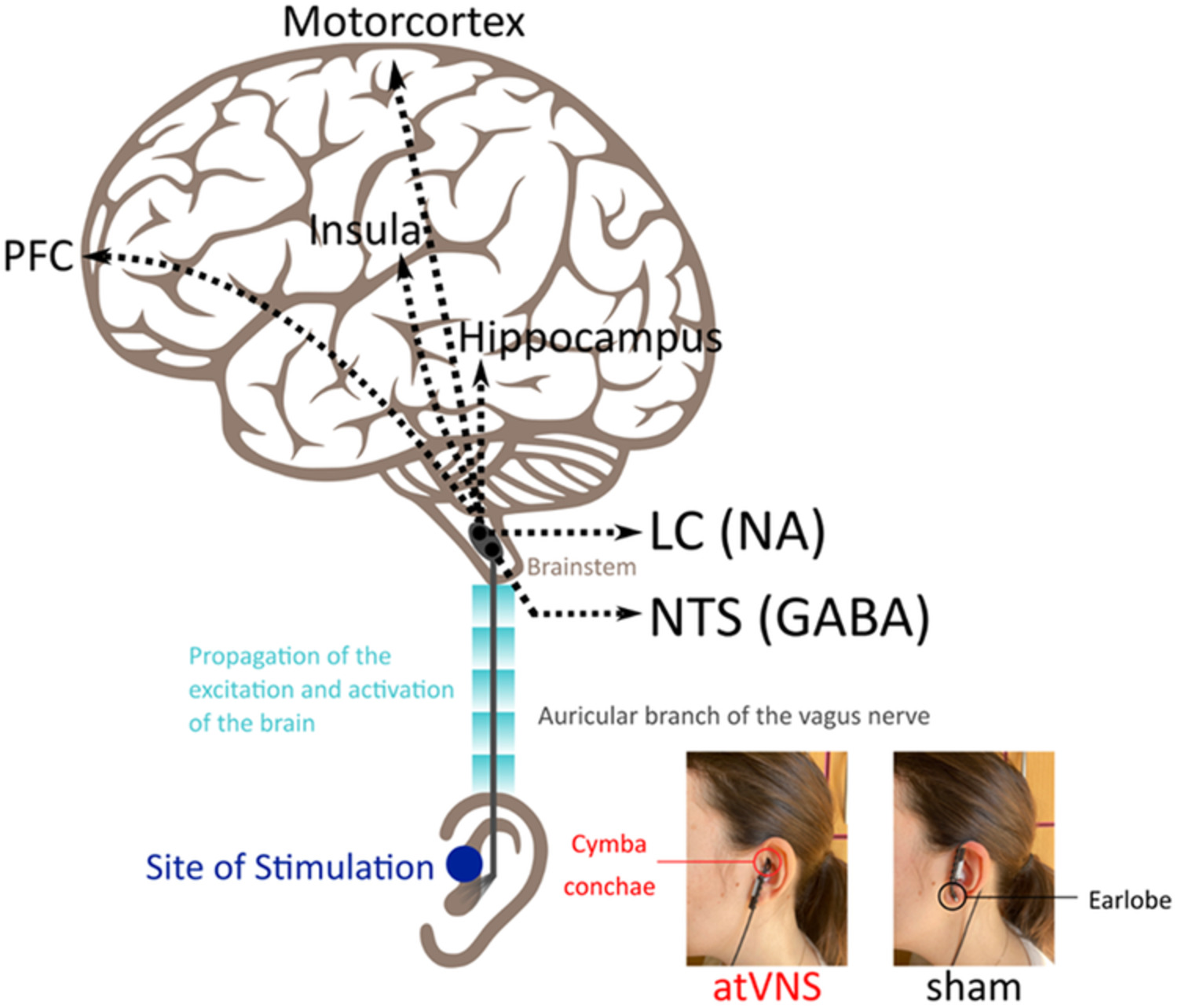 Auricular transcutaneous vagus nerve stimulation for alcohol use disorder: A chance to improve treatment?