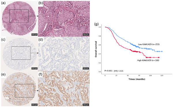 Comprehensive analysis of the prognostic impact and immune implication of KIAA1429 in lung adenocarcinoma