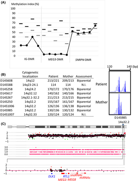 Temple syndrome diagnosed in an adult patient with clinical autism spectrum disorder