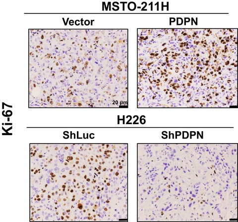 Podoplanin promotes progression of malignant pleural mesothelioma by regulating motility and focus formation