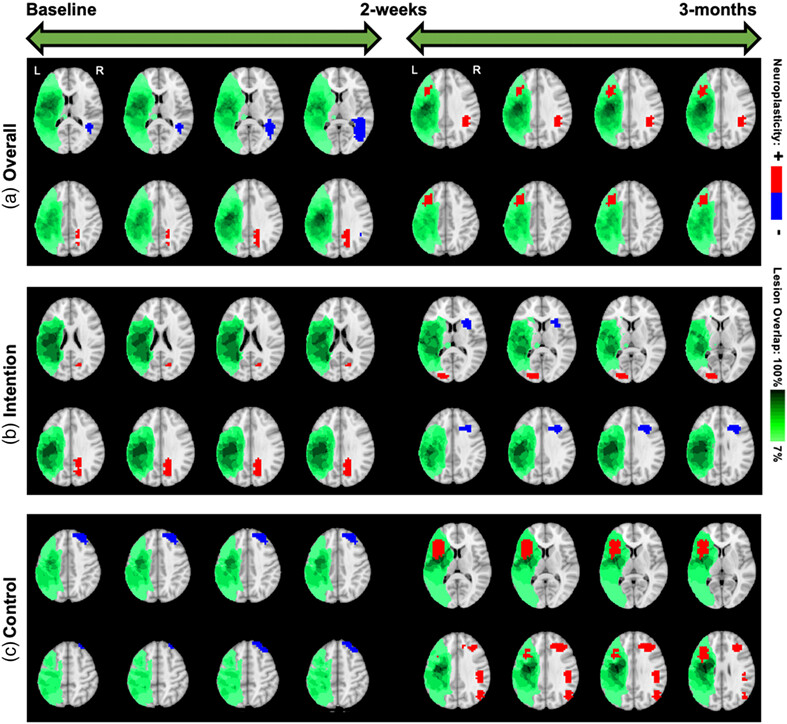 Bayesian longitudinal tensor response regression for modeling neuroplasticity